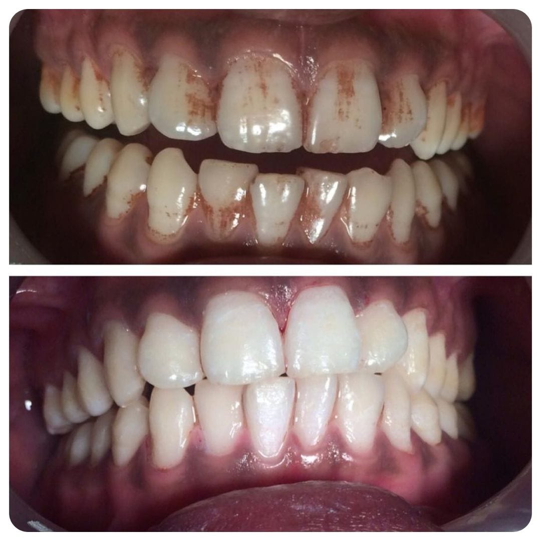 Customer photo review of Blinqo Teeth Whitening Pen