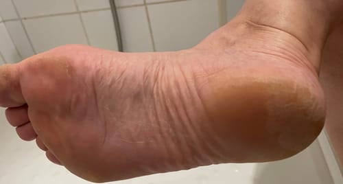 Customer photo review of LOVASKIN INSTANT FOOT PEEL Deluxe Kit - 25 applications or less than 3.20 per treatment