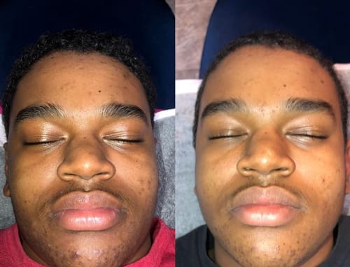 Customer photo review of Acne & Wrinkle Fighting Tallow Balm – 5 Pack