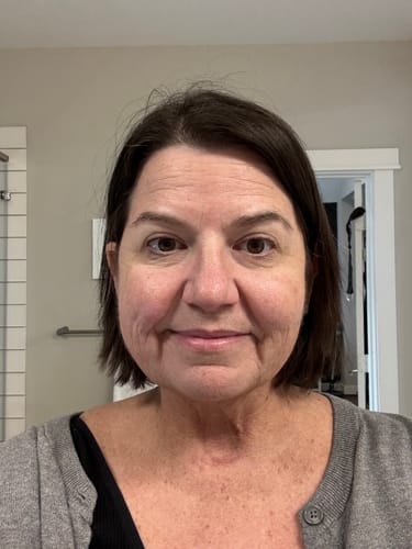 Customer photo review of 3 Month Supply - Seranova Micro Infusion System