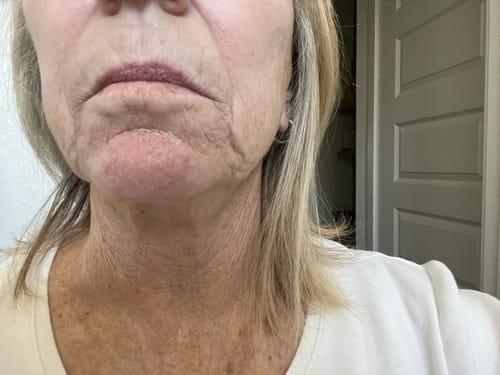 Customer photo review of 3 Month Supply - Seranova Micro Infusion System