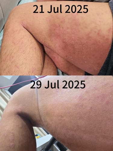 Customer photo review of Eczema Scratch Mitten