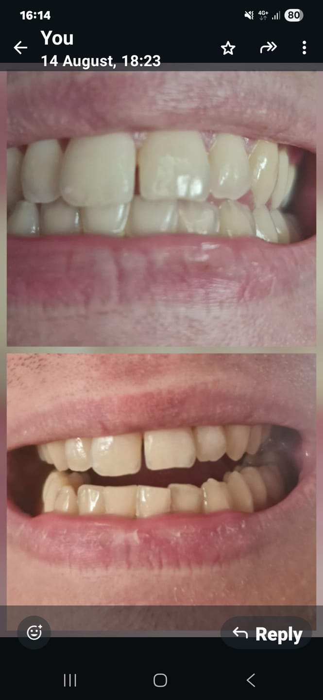 Customer photo review of Teeth Whitening Kit