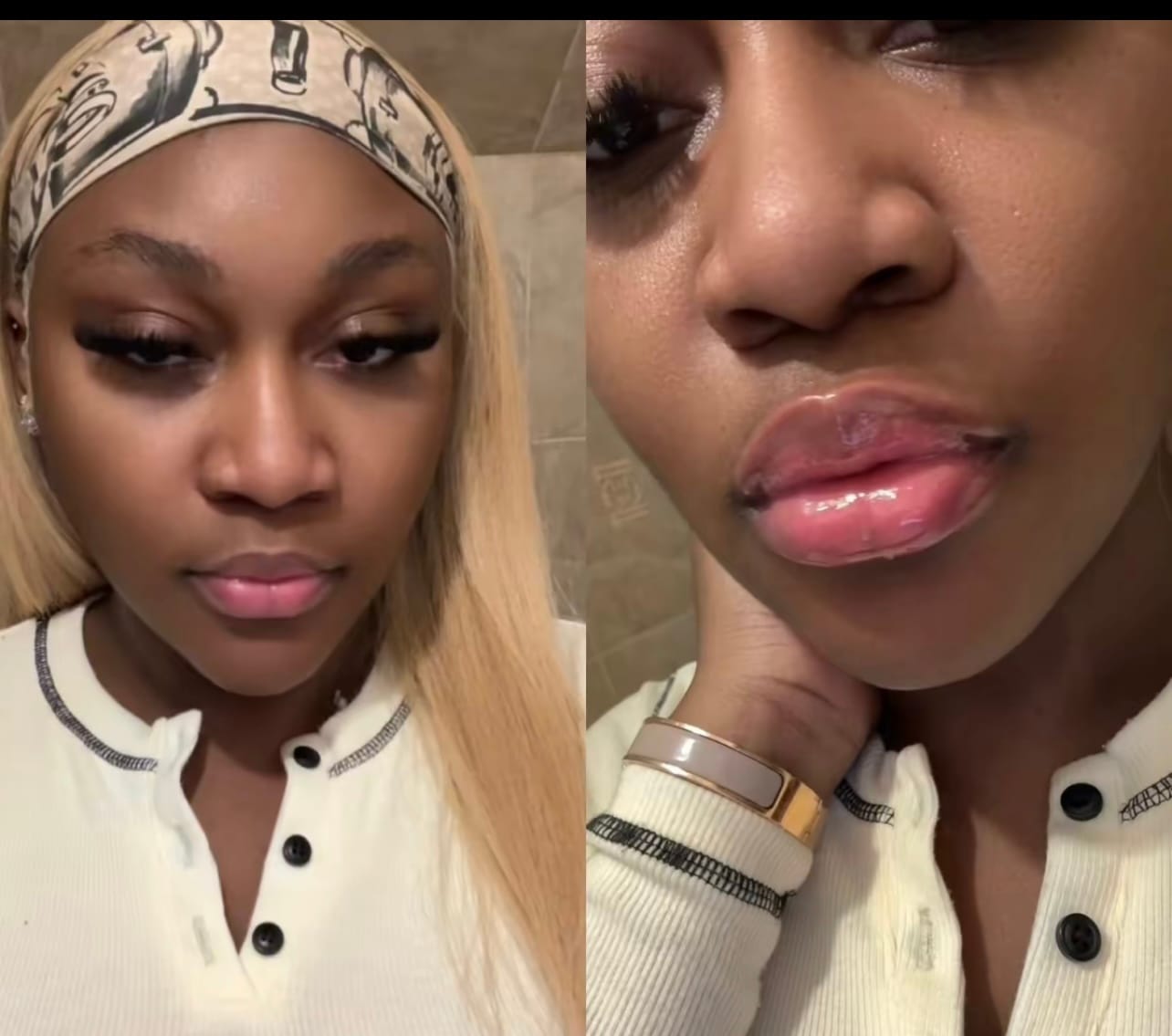 Customer photo review of Plumping Lip filler