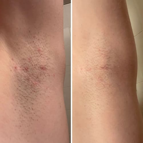 Customer photo review of Hot & Hairless