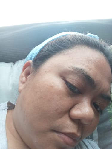 Customer photo review of Bad Skin™ Korean Collagen Bomb Hydrating Ampoule