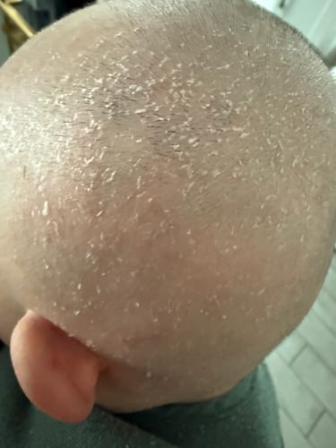 Customer photo review of Bye-Bye Cradle Cap