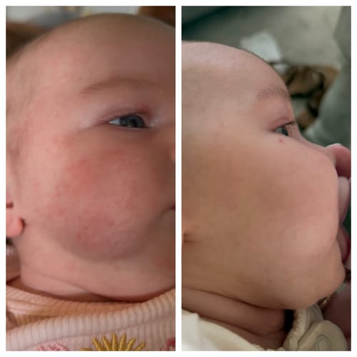 Customer photo review of All Over Ointment Eczema Treatment