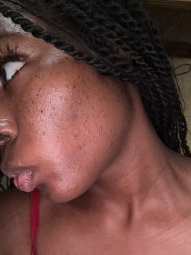 Customer photo review of 2IN1 DOUBLE CLEANSING BAR | ACNE RELIEF | DISCOLORATION CORRECTOR