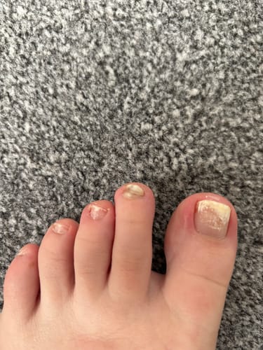 Customer photo review of Fungal Freedom