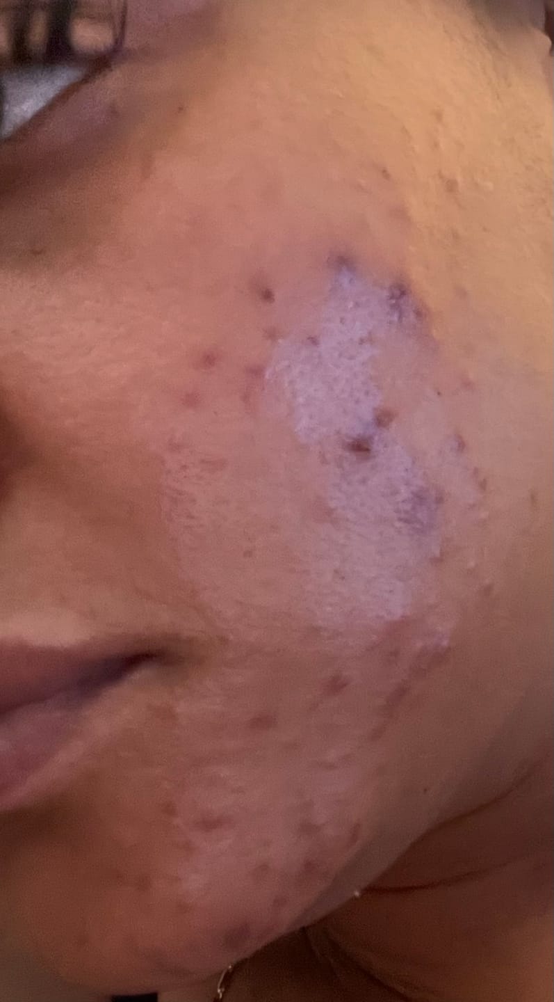 Customer photo review of Dark Spot Eraser Lotion