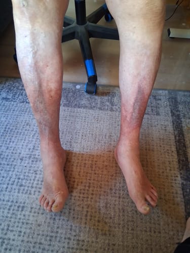 Customer photo review of Diasocks Stödstrumpor