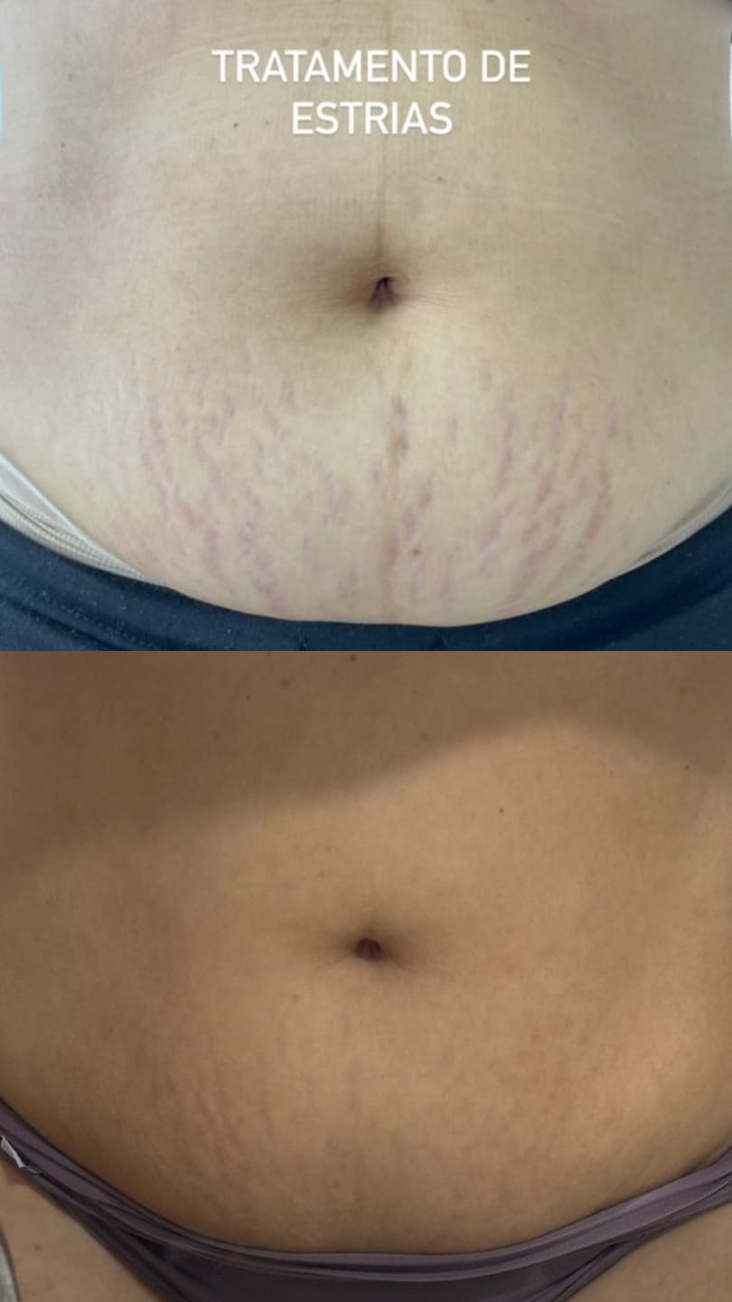 Customer photo review of Daily Tratamento - Creme Para Estrias