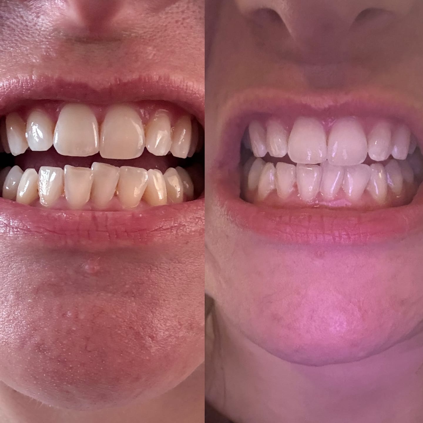 Customer photo review of Teeth Whitening Strips