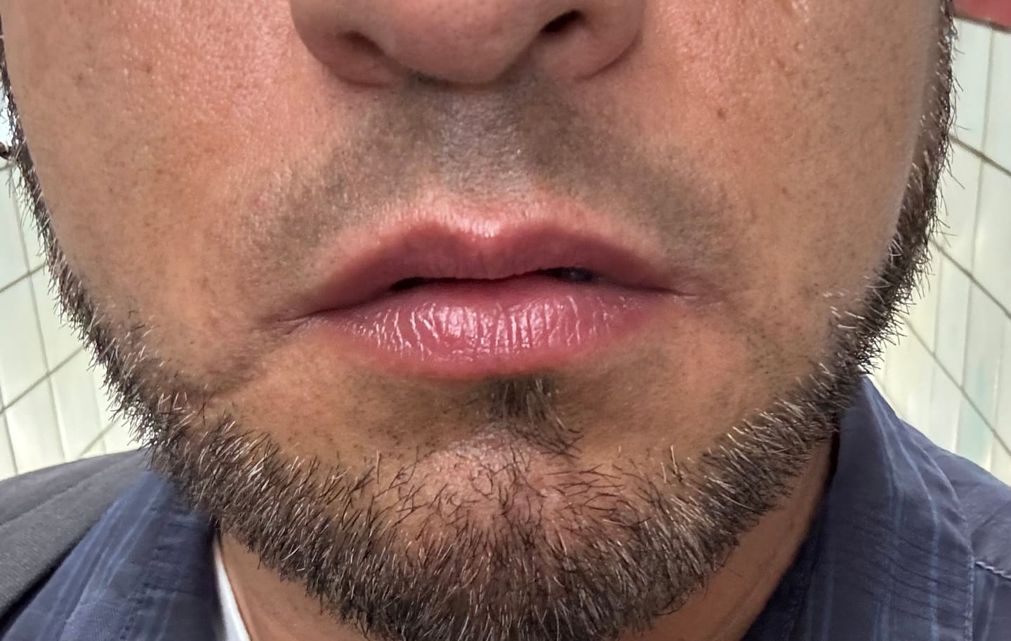 Customer photo review of Lips Lightening Cream For Men and Women (Results in 5 Days or Less)