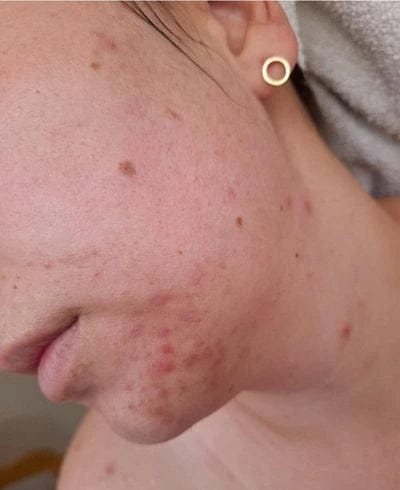 Customer photo review of PDRN Micro-Infusion Skin Booster