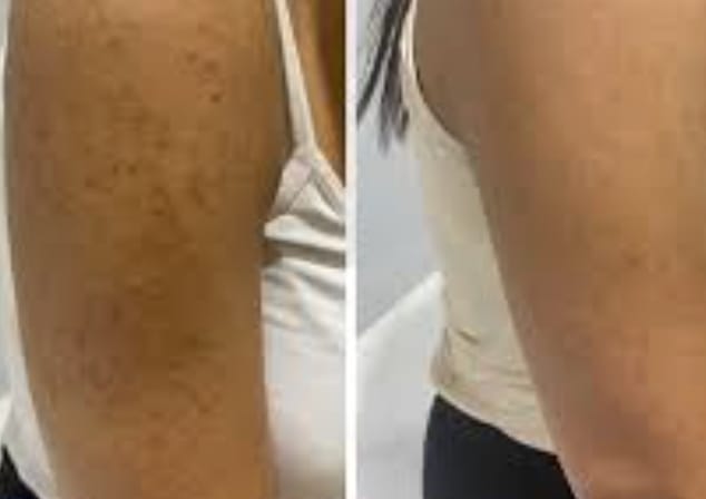 Customer photo review of Crème Lissante Purifiante  – Boutons, Kératose & Texture Irrégulière