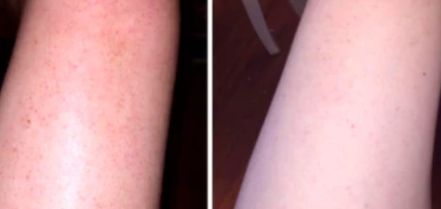 Customer photo review of Crème Lissante Purifiante  – Boutons, Kératose & Texture Irrégulière