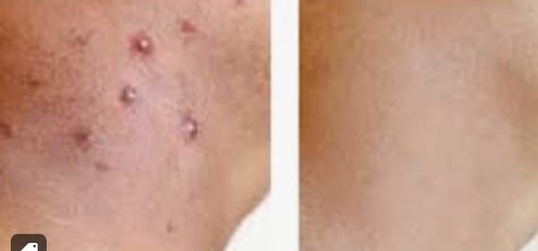 Customer photo review of Crème Lissante Purifiante  – Boutons, Kératose & Texture Irrégulière