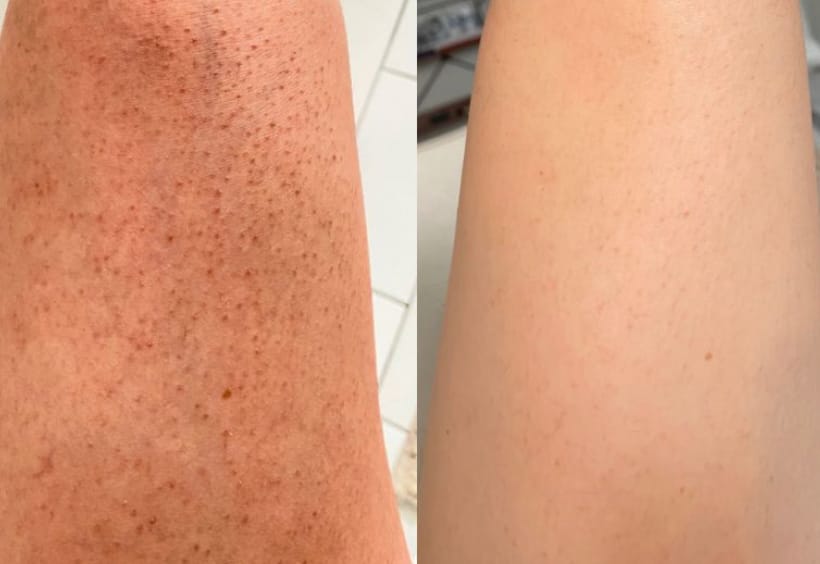 Customer photo review of Crème Lissante Purifiante  – Boutons, Kératose & Texture Irrégulière