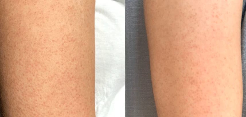 Customer photo review of Crème Lissante Purifiante  – Boutons, Kératose & Texture Irrégulière