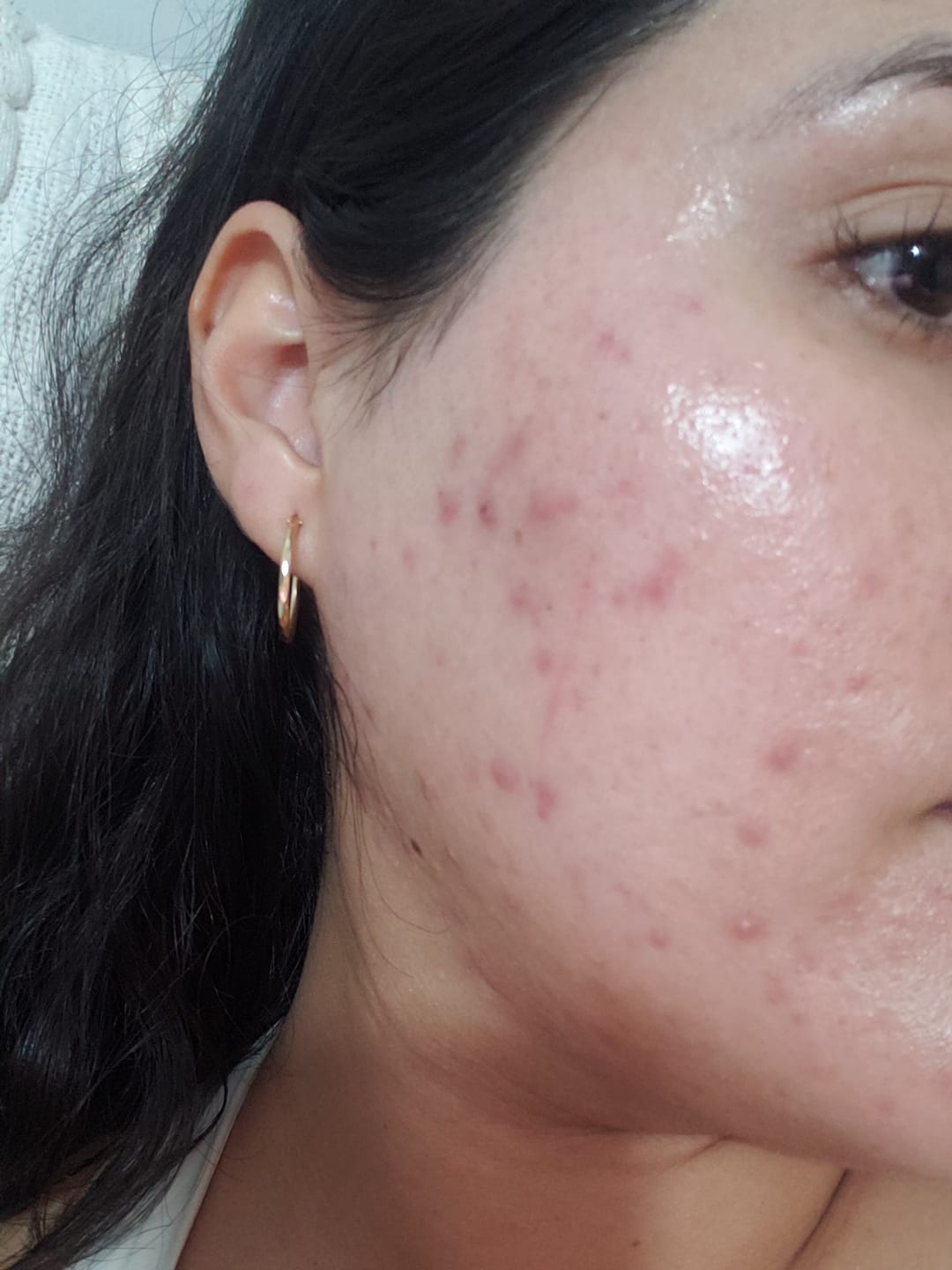 Customer photo review of ANUA - Niacinamide 10% + TXA 4% Serum 30 ML | Suero Antimanchas