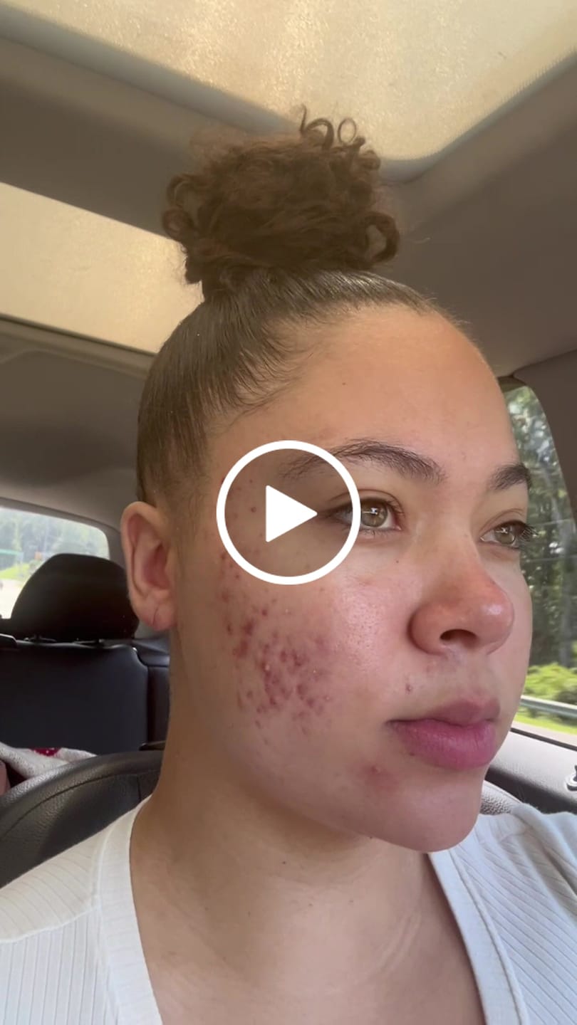 Customer video review of LIMITED EDITION: Jolie’s Mini Full Body & Face Brightening Kit/ Acne Kit