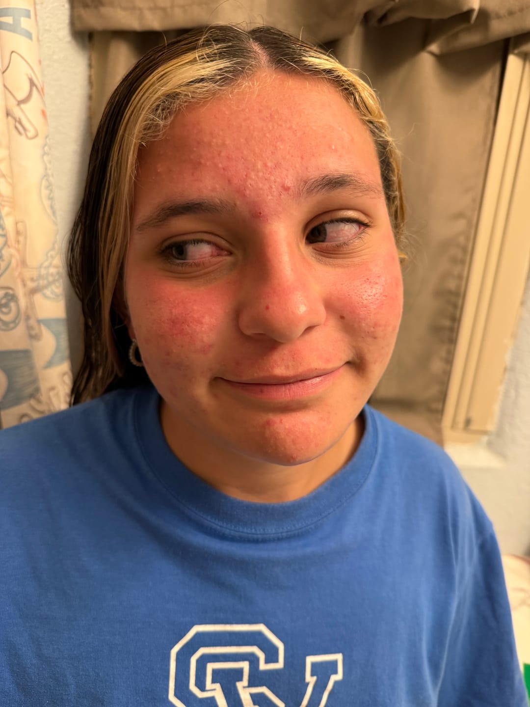 Customer photo review of Kill Acne & Redness Ritual