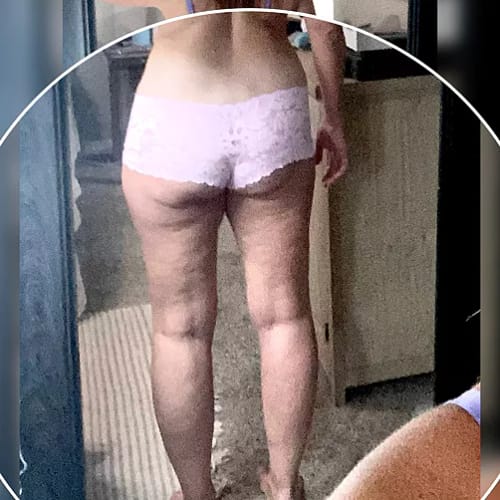 Customer photo review of ⁠ ⁠Serum para las Celulitis - 30 ml