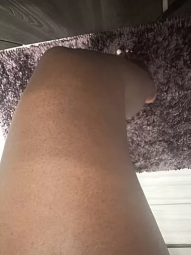 Customer photo review of ⁠ ⁠Serum para las Celulitis - 30 ml