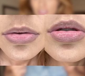 Customer photo review of Voluminizador de Lábios GLUMI