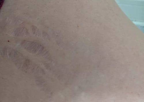 Customer photo review of Serum para las Estrias - 30 ml