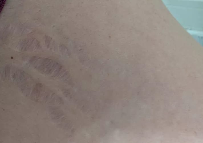 Customer photo review of Serum para las Estrias - 30 ml