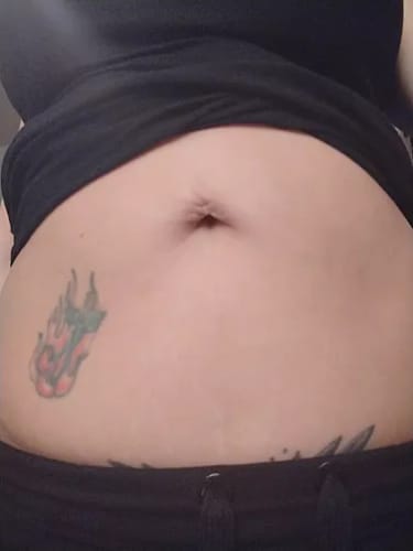 Customer photo review of Serum para las Estrias - 30 ml