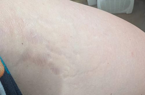 Customer photo review of Serum para las Estrias - 30 ml