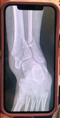 Customer photo review of RECOVER [Ultra Wound Support]