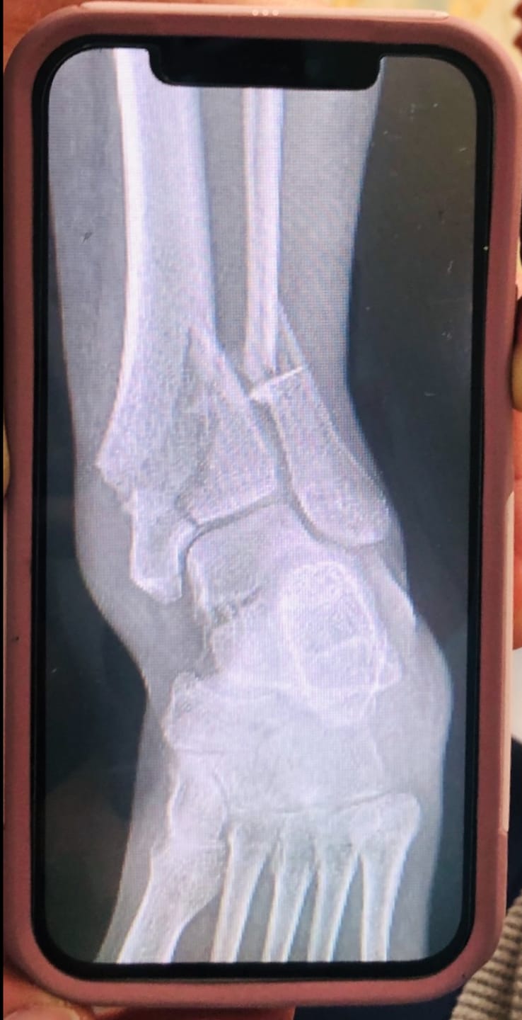 Customer photo review of RECOVER [Ultra Wound Support]