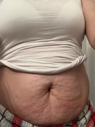 Customer photo review of Serum para las Estrias - 30 ml