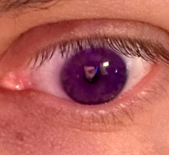 Customer photo review of Eyeling Custom Lens – 1 Month