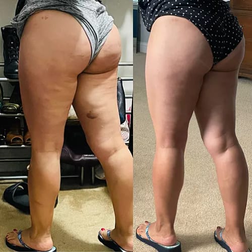 Customer photo review of ⁠ ⁠Serum para las Celulitis - 30 ml