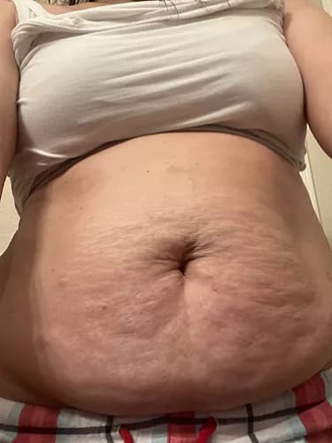 Customer photo review of Serum para las Estrias - 30 ml