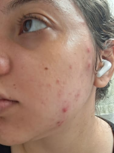 Customer photo review of SOME BY MI - 30 Days Miracle AC SOS Kit - 4 piezas