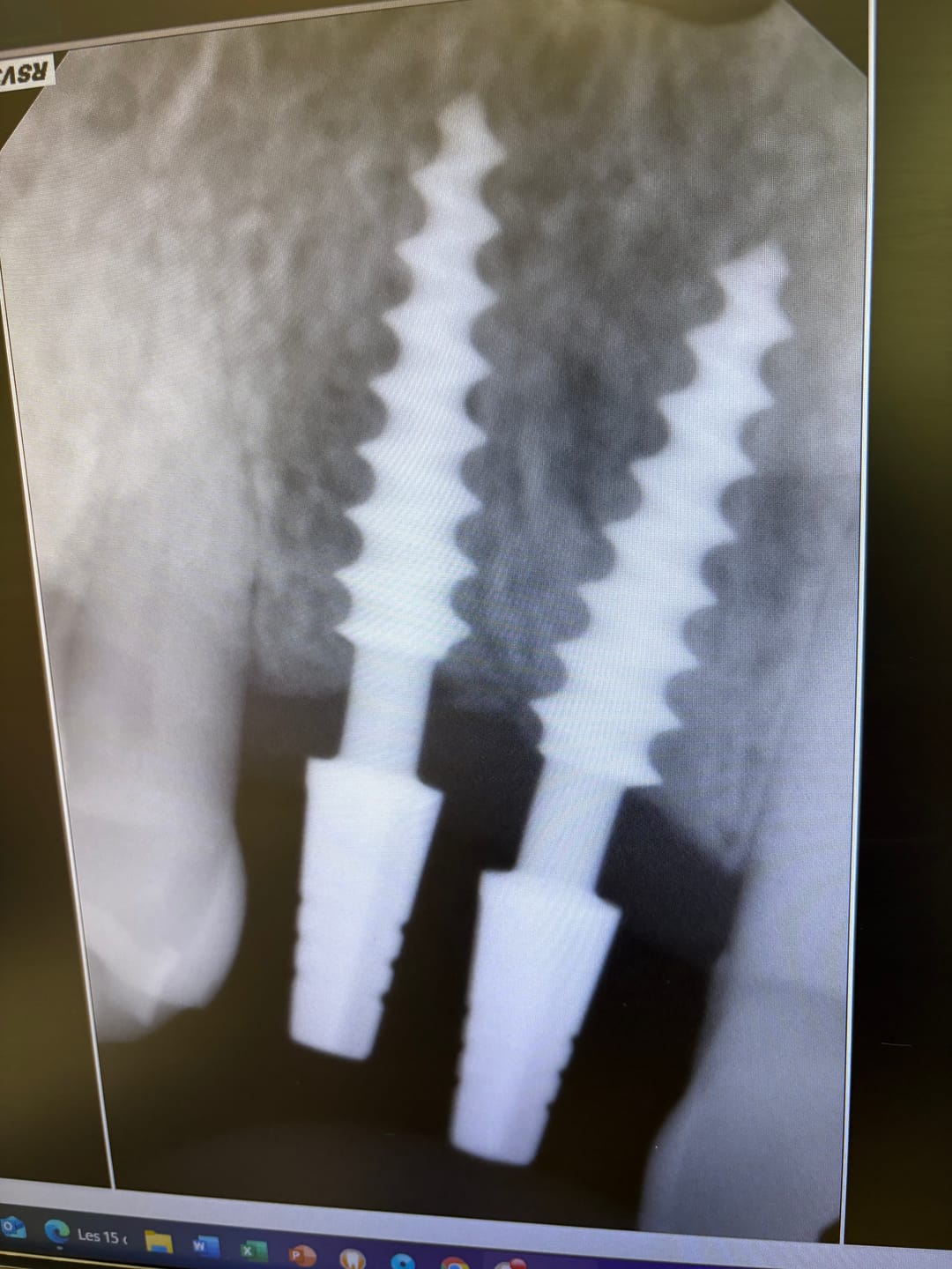 Customer photo review of ALTO® One-Piece Dental Implant Ø3.5 - Monoblock System