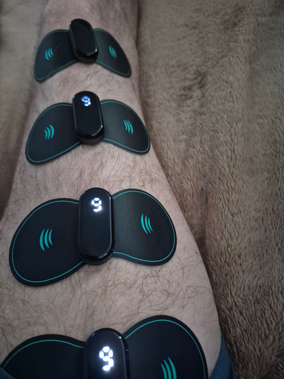 Customer photo review of Vibit TENS - Wireless Electrical Muscle Stimulator