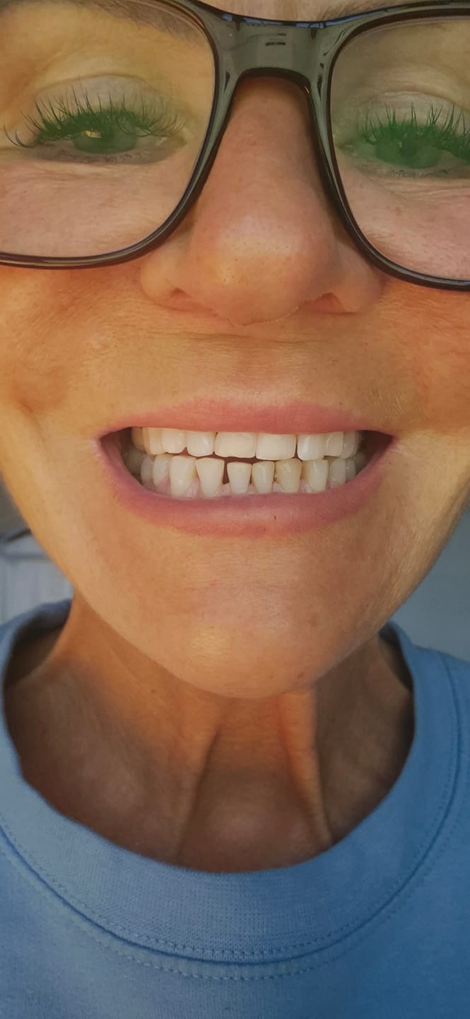 Customer photo review of Teeth Whitening Strips