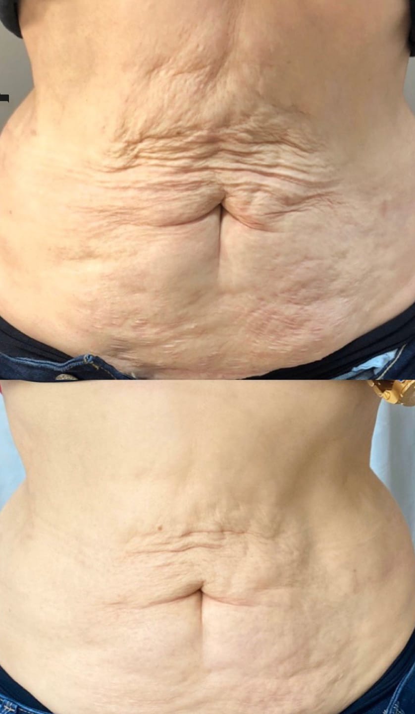 Customer photo review of Firméa® Reafirma e Hidrata la piel flácida