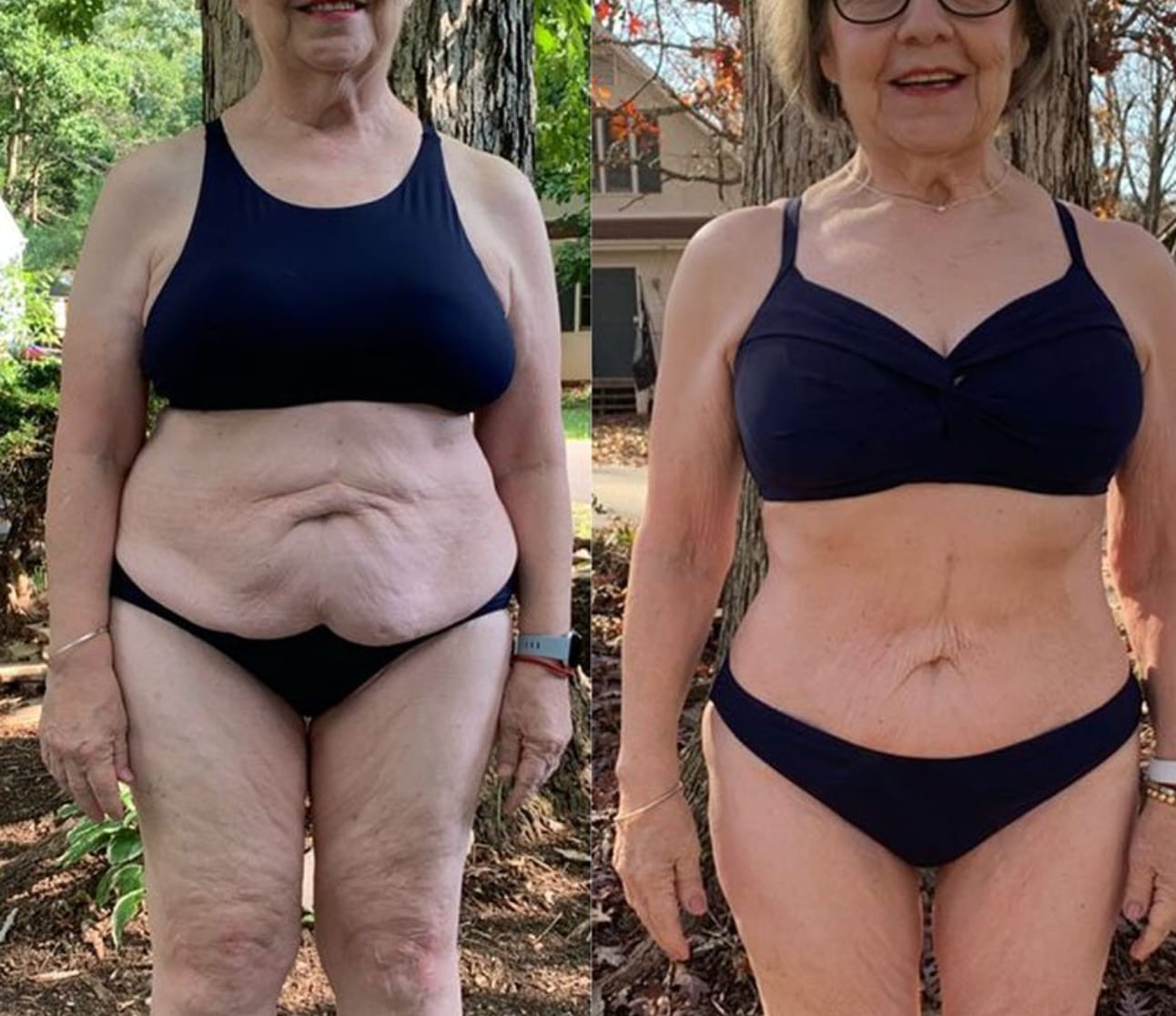 Customer photo review of Firméa® Reafirma e Hidrata la piel flácida