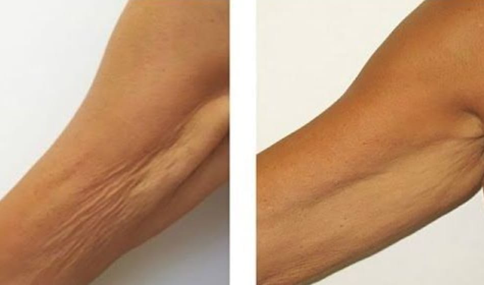 Customer photo review of Firméa® Reafirma e Hidrata la piel flácida