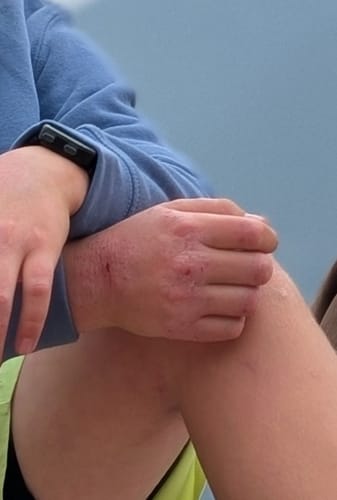 Customer photo review of F-Balm - Premium Anti-aging Tallow Balm - 2 oz.