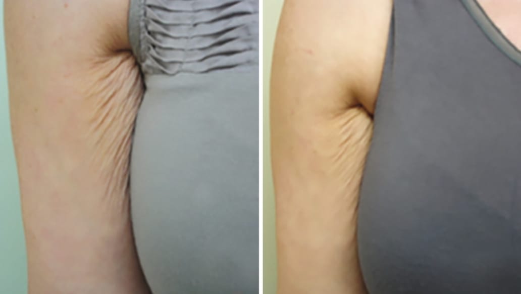 Customer photo review of Firméa® Reafirma e Hidrata la piel flácida